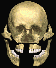 Animated illustration of a skull with facial trauma