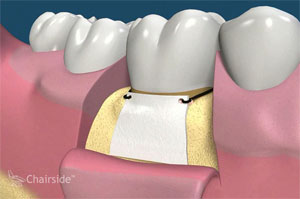 Digital illustration of the guided tissue regeneration process