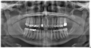 Panoramic X-ray of a patient's teeth