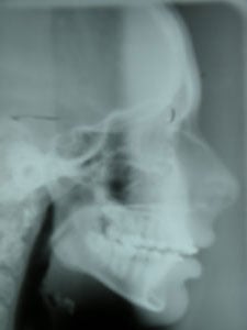 Radiograph of a skeleton