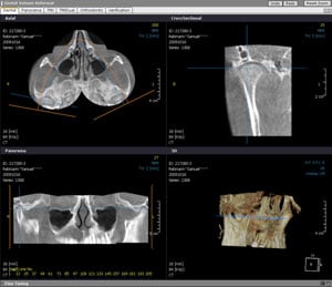 TMJ radiographs