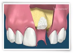 Digital illustration of a tooth socket filled with graft material