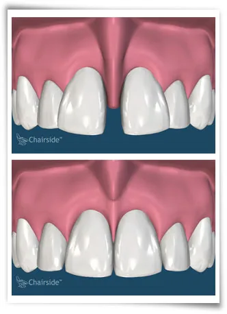 Digital illustration of a mouth before and after a frenectomy
