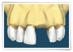 Digital illustration of a healed tooth socket after being filled with graft material