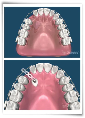 Digital illustration of a mouth before and after attaching a chain to an impacted tooth