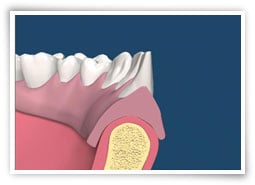 Digital illustration of a cross section of a jaw after surgery to remove a soft tissue abnormality