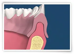 Digital illustration of a cross section of a jaw with a soft tissue abnormality before surgery