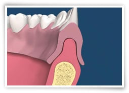 Digital illustration of a cross section of a jaw with a soft tissue abnormality before surgery
