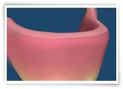 Digital illustration of a mouth after surgery to remove a soft tissue abnormality