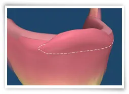 Digital illustration of a soft tissue abnormality before surgery