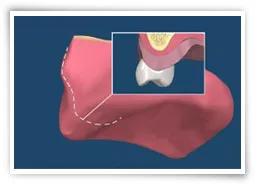 Digital illustration of a mouth after surgery to remove excess tissue growth