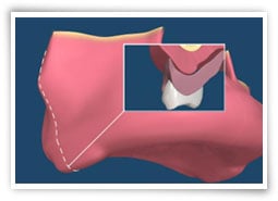 Digital illustration of excessive tissue growth before surgery