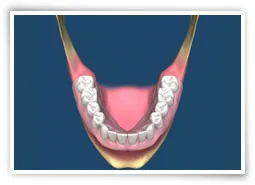 Digital illustration of a lower jaw with dentures with adequate lingual flanges