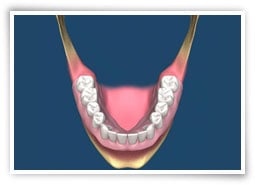 Digital illustration of a lower jaw with dentures with adequate lingual flanges