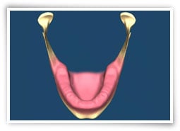 Digital illustration of a lower jaw after surgery to remove mandibular tori
