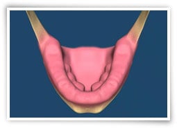 Digital illustration of mandibular tori before surgery