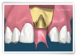 Digital illustration of an empty tooth socket