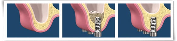 Digital illustration of the sinus lift process