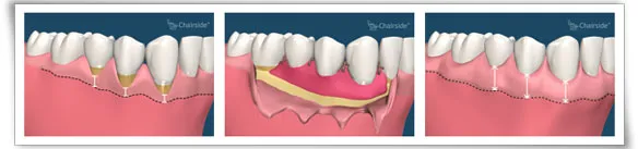 Digital illustration of the gum grafting process